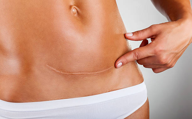 Can Surgical Scar Revision Remove Deep Facial Scars