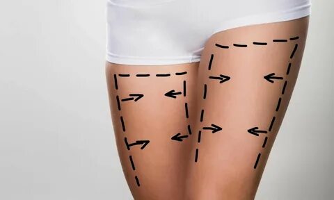 Can Thigh Lift Eliminate Chafing Between the Legs