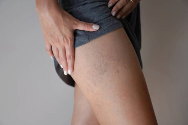 Can Varicose Veins Treatment Remove Bulging Veins