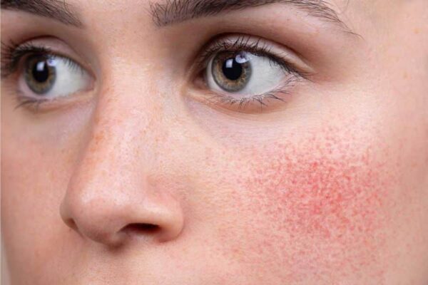 Does Rosacea Treatment Eliminate Facial Flushing?