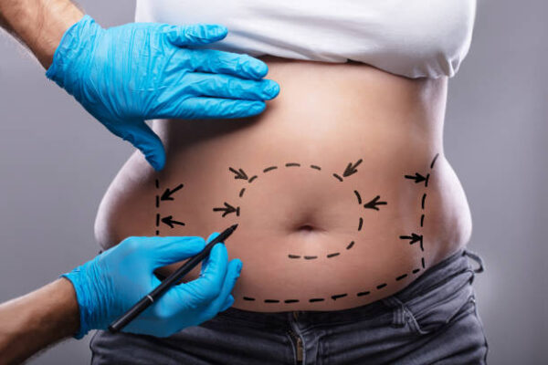 How Painful Is Liposuction Surgery Recovery?