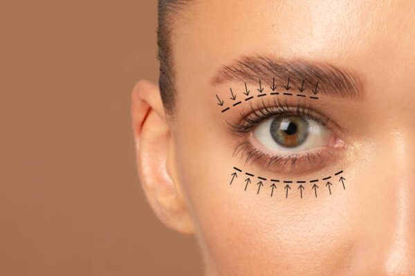 What Eyelid Surgery Success Rates Look Like?