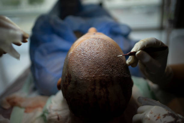 What Makes FUE Hair Transplant a Popular Choice Today?