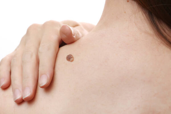 What Makes Warts Removal Treatment a Reliable Choice