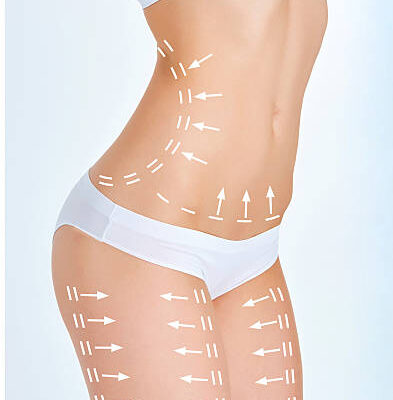 Why Choose Bodytite Liposuction for Fat Reduction