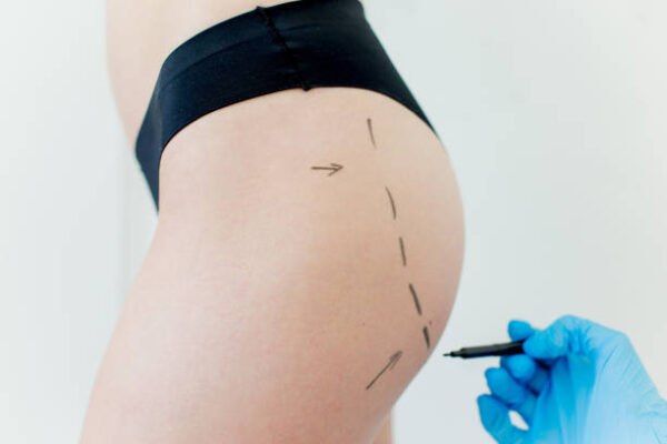 Why Choose Buttock Augmentation for Confidence Boost