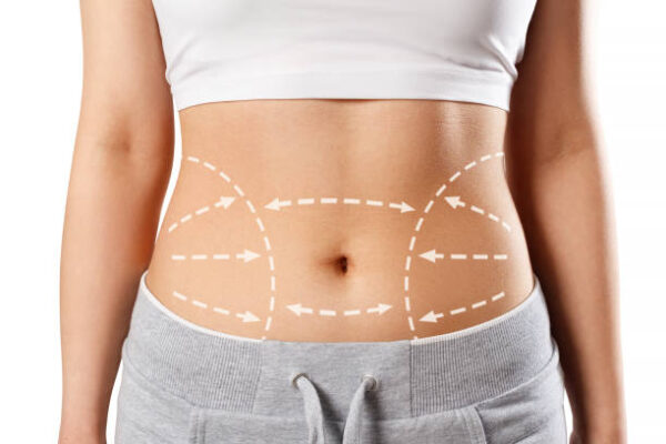 Why Choose Liposuction for Long-Lasting Fat Reduction