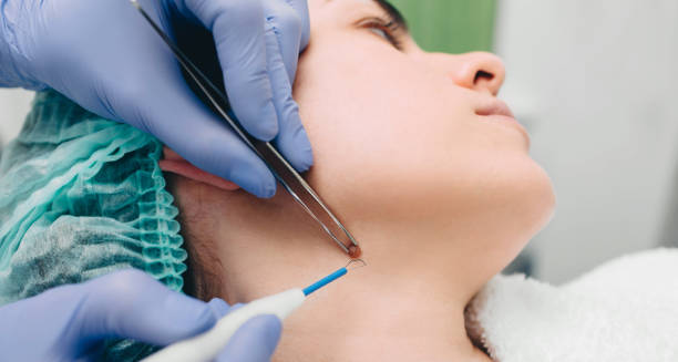 Why Choose Mole Removal for Cosmetic Confidence