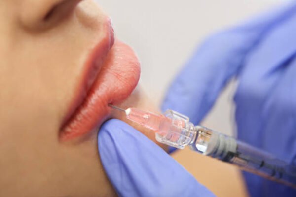 Why Lip Fillers Are Popular Among Young Adults