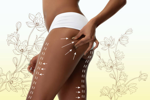 Can Buttock Augmentation Boost Body Confidence