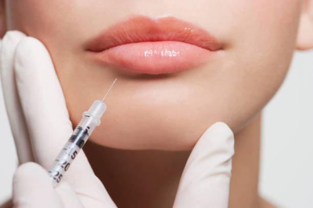 Can Russian Lip Fillers Fix Uneven Lip Volume