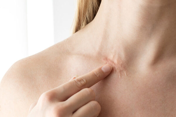 Can Surgical Scar Revision Smooth Deep Scars? Can Surgical Scar Revision Smooth Deep Scars