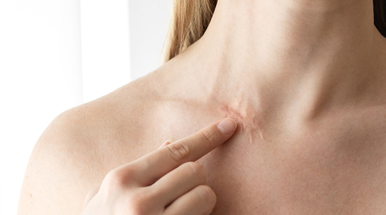 Can Surgical Scar Revision Smooth Deep Scars