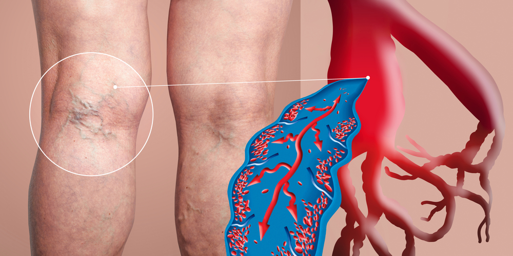 Deep Vein Thrombosis Treatment in Jaipur