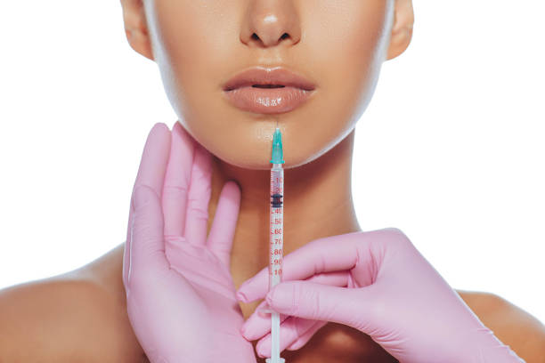 Defined Lips Shape with Russian Lip Fillers