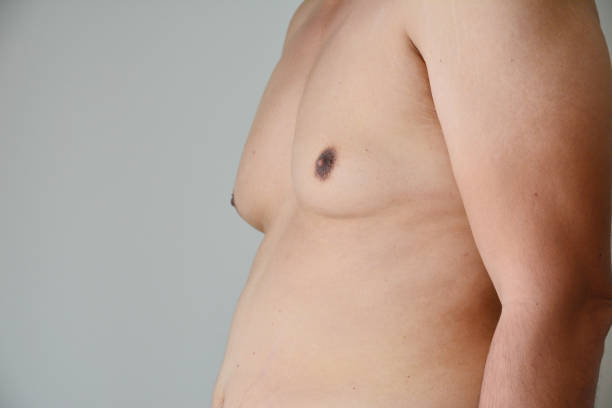 Does Gynecomastia Surgery Affect Muscle Definition?