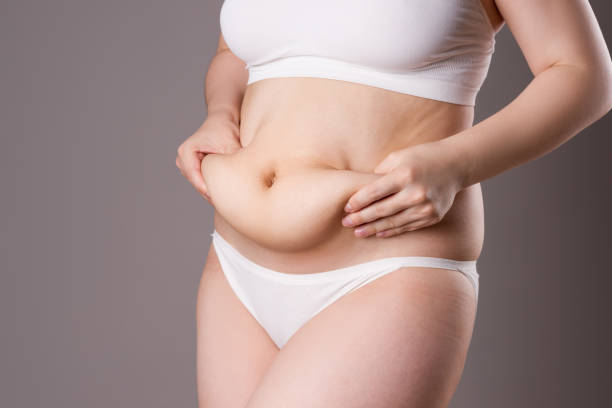 Does Tummy Tuck Surgery Tighten Loose Skin?