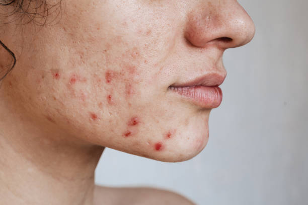 How Does Acne Treatment Improve Skin Texture?