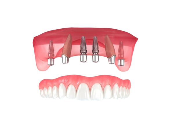Dental Implant Problems: Understanding the Challenges and Solutions Top 7 Dental Implants