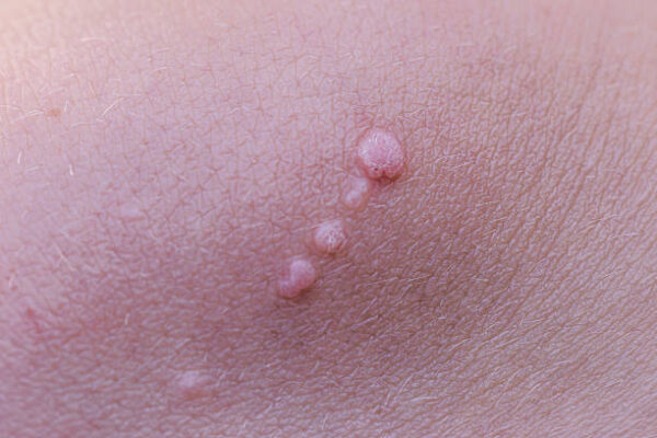 What Causes Warts and How Genital Warts Removal Helps ? What Causes Warts and How Genital Warts Removal Helps