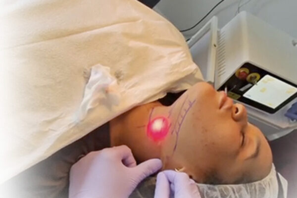 What Should You Expect After an Endolift Session? What Should You Expect After an Endolift Session