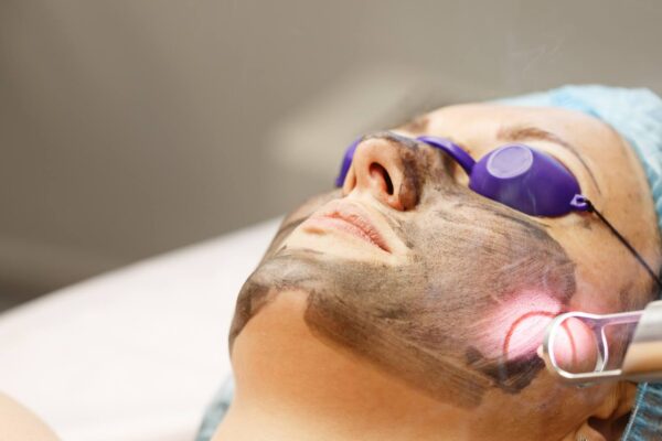 Is Laser Carbon Peel Good for Oily and Acne-Prone Skin? Is Laser Carbon Peel Good for Oily and Acne-Prone Skin?