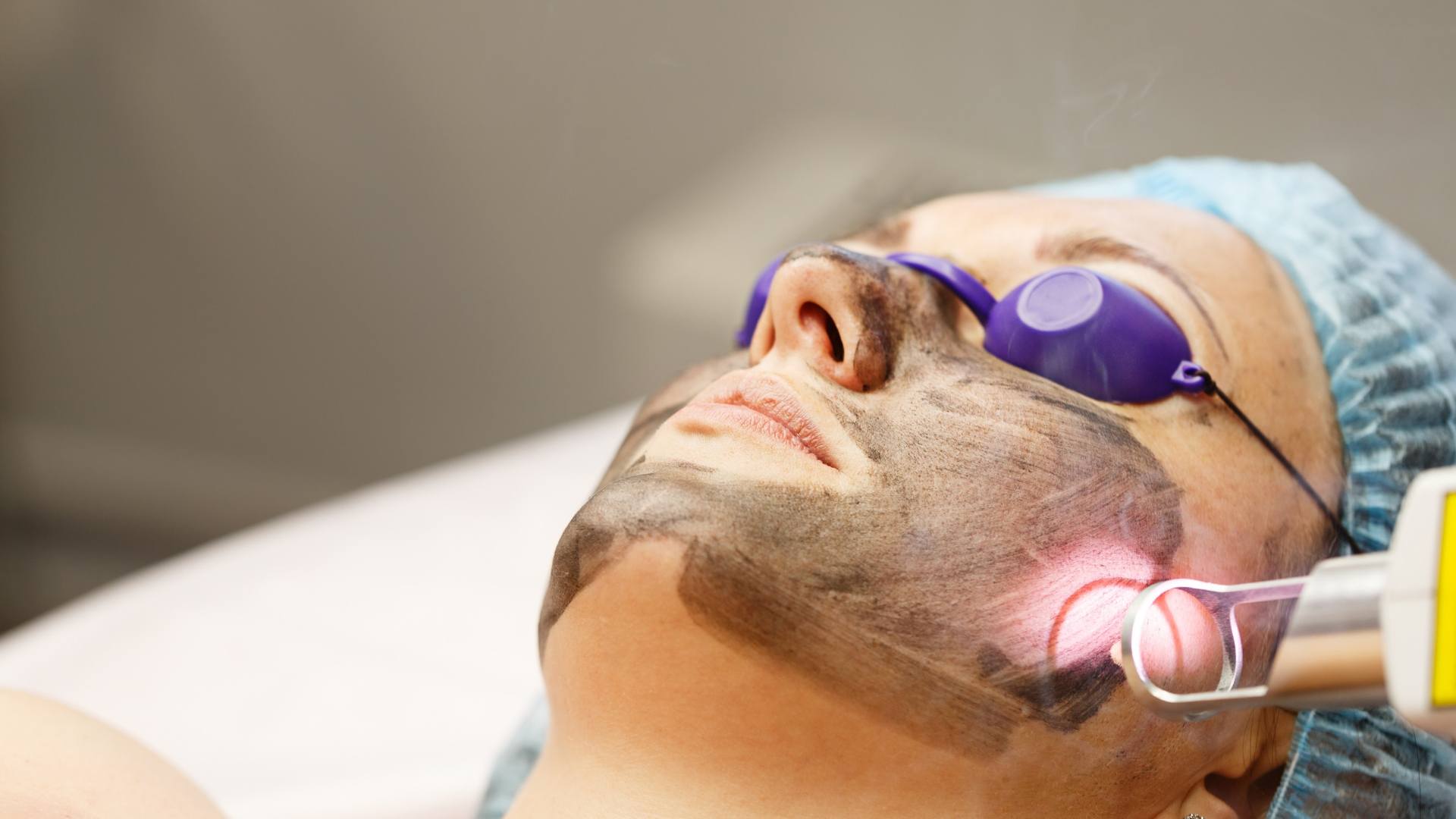 Is Laser Carbon Peel Good for Oily and Acne-Prone Skin?