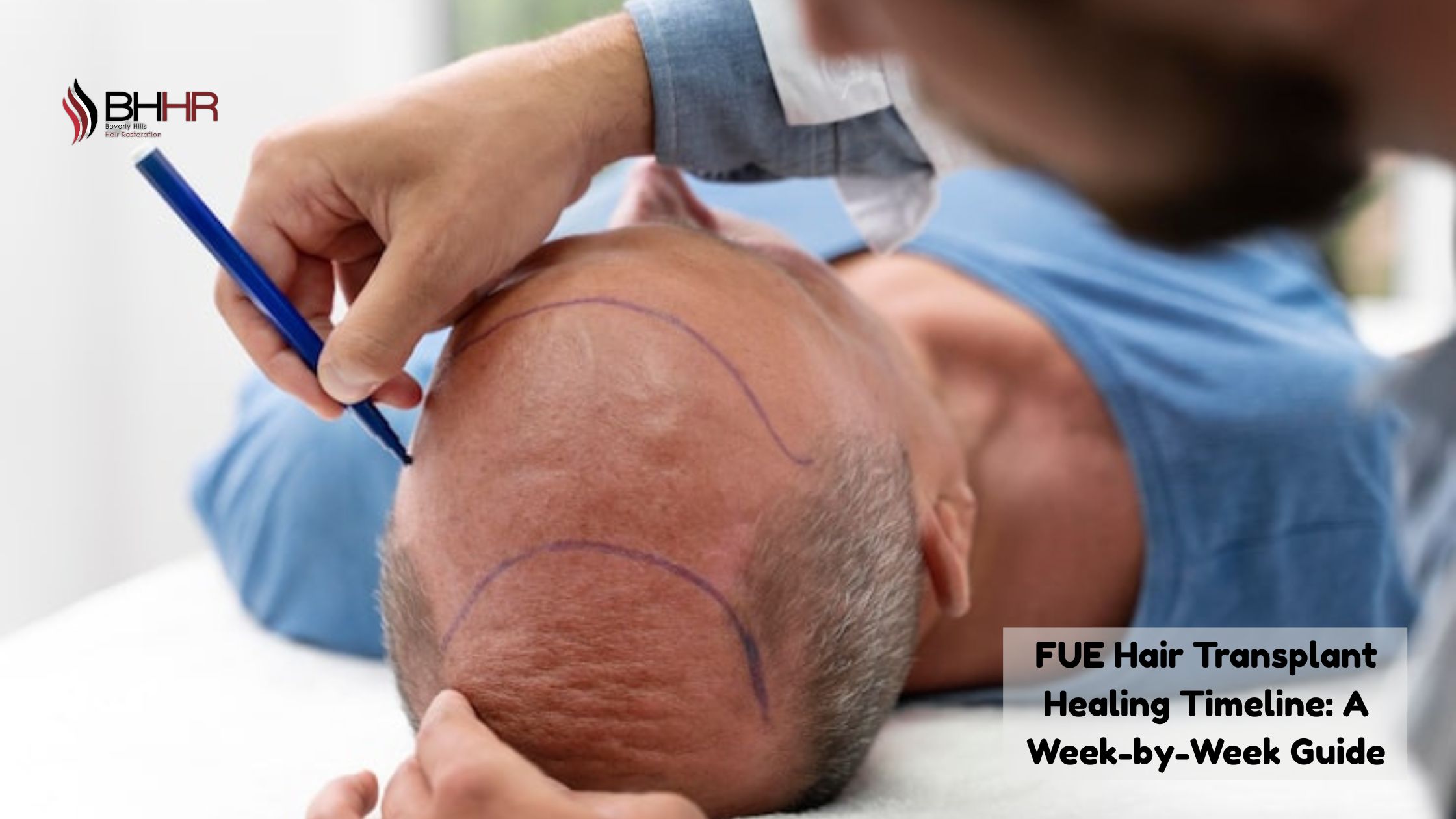 fue hair transplant