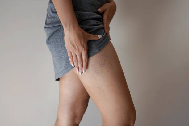 Can Varicose Veins Treatment Prevent Future Veins