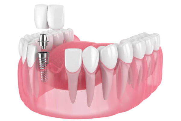 Do Dental Implants Last Longer Than Other Options