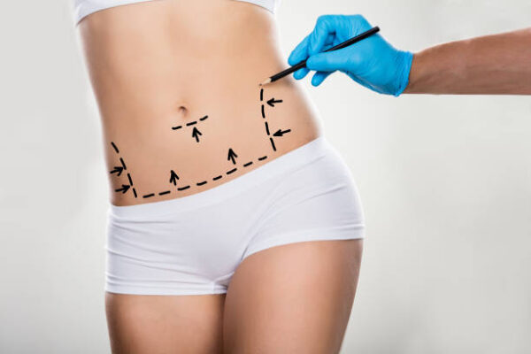 How Lipo Abdominoplasty Creates a More Defined Waistline