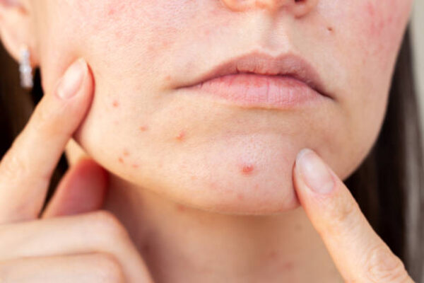 Laser Acne Scar Treatment for Boosting Skin Confidence