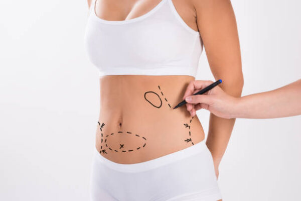 What Makes Liposuction Ideal for Body Refinement