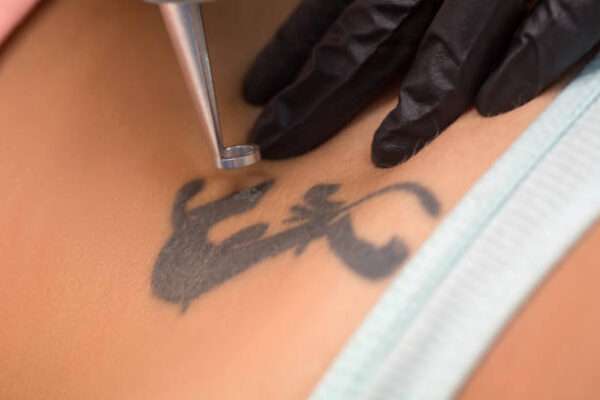 What to Expect During Laser Tattoo Removal Sessions