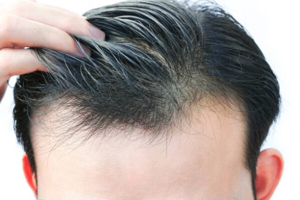 Why People Choose Hair Loss Treatment for Fast Results