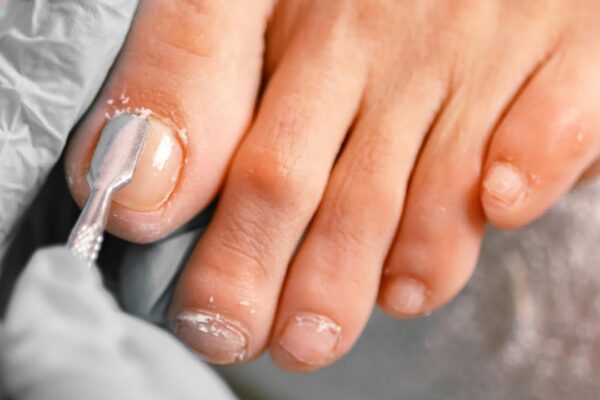 Where to Treat Toenail Fungus Safely and Effectively in Edinburgh