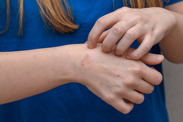 Can Eczema Treatment Help Stop Constant Scratching