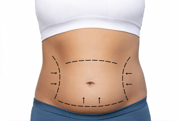 Can Liposuction Help Achieve a Sculpted Waistline