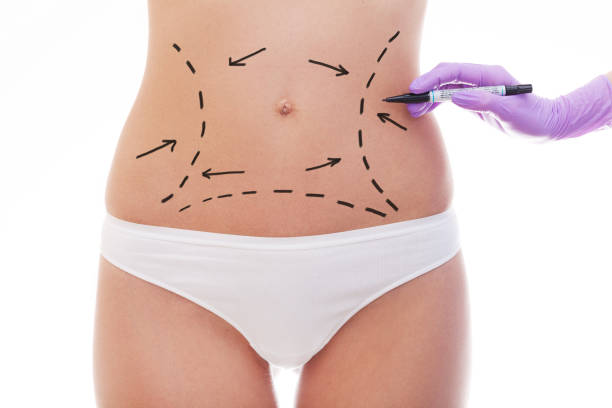 Can Liposuction Help After Major Weight Loss