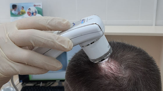 Can a Trichologist Help With Alopecia