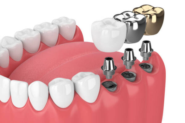 Do Dental Implants Require Special Aftercare