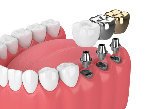 Do Dental Implants Require Special Aftercare