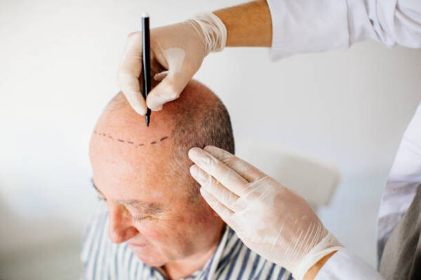 Does FUE Hair Transplant Work for Thin Hair