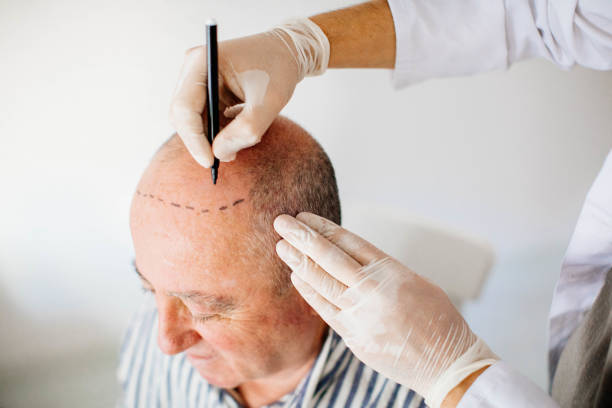 Does FUE Hair Transplant Work for Thin Hair