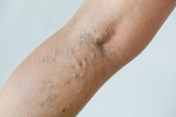 Is Sclerotherapy the Best Option for Veins