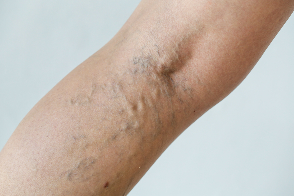 Is Sclerotherapy the Best Option for Veins