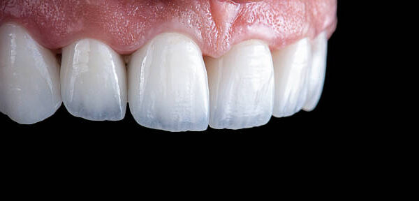 Why So Many Choose E-Max Veneers for Smile Upgrade