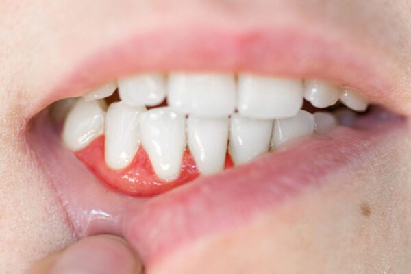Can Gum Recession Treatment Fix Sensitive Teeth