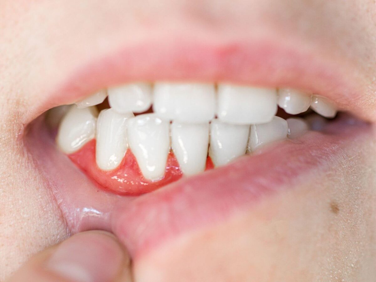 Can Gum Recession Treatment Fix Sensitive Teeth