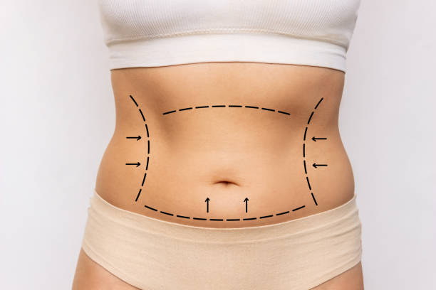 Can Weight Fluctuations Affect Tummy Tuck Results